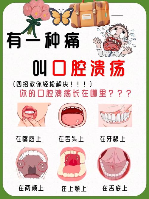 口腔溃疡的应对措施
